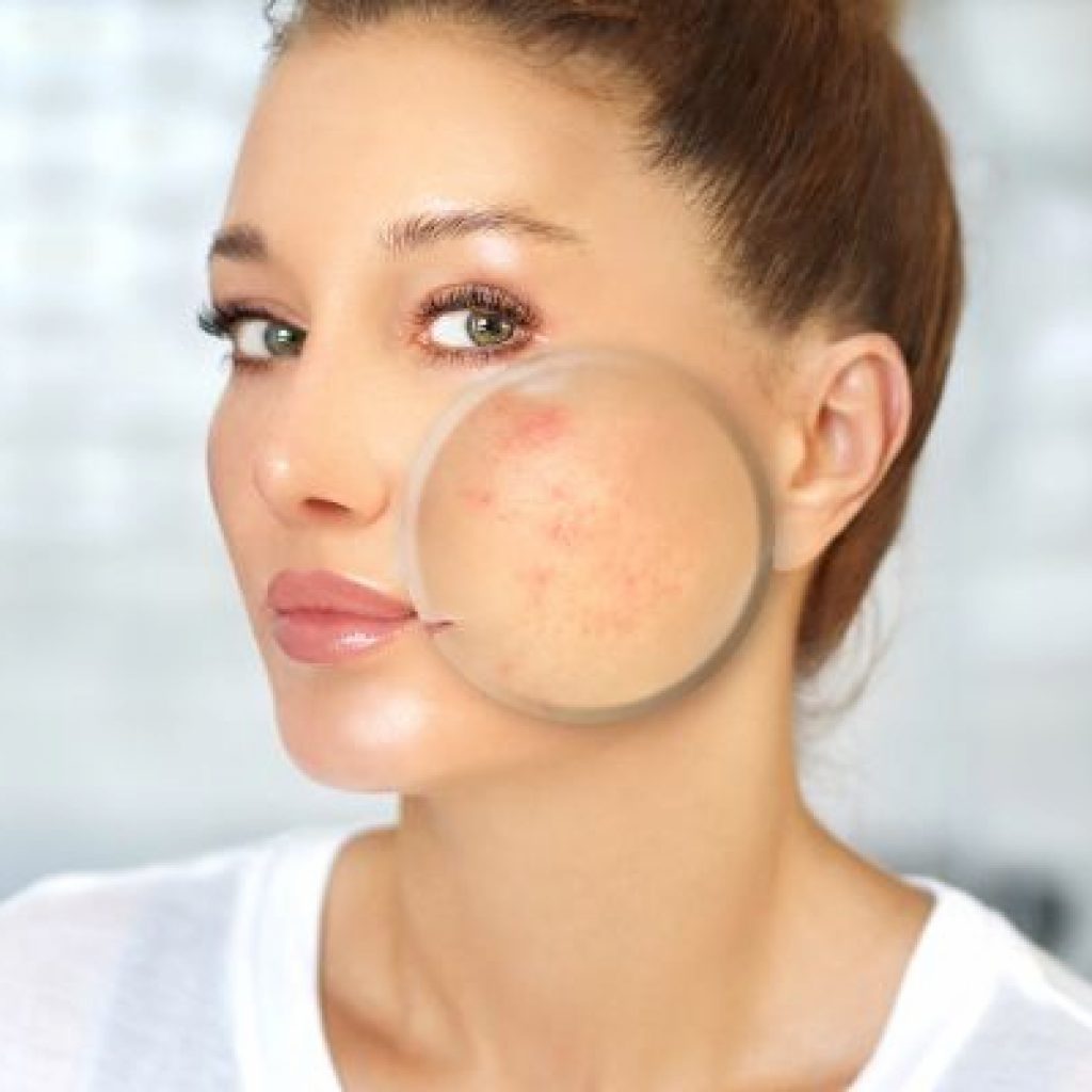 the most effective acne scar treatments