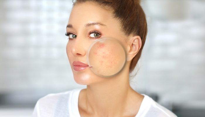 the most effective acne scar treatments