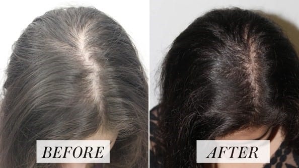 Womens Hair Restoration