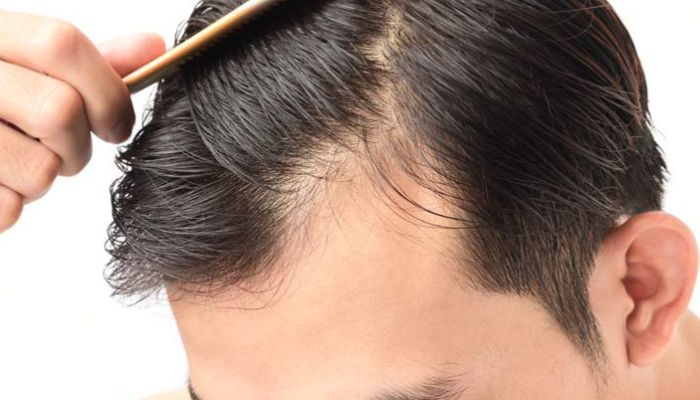 prevent hair loss - tips from the best hair restoration specialist