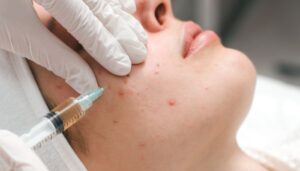 Kenalog Injection: The Quick Fix for Acne Troubles!