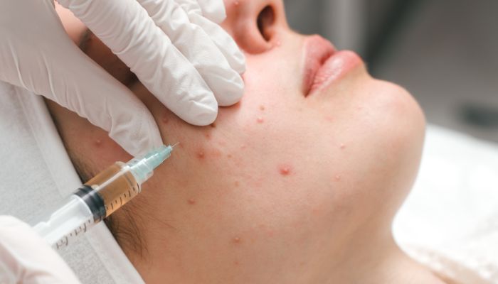 Kenalog Injection: The Quick Fix for Acne Troubles