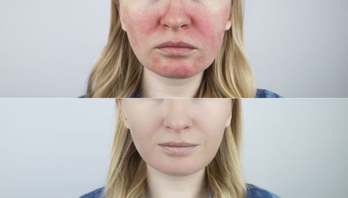 Discover the Power of Excel V Rosacea Laser Treatment