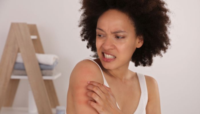 Shielding Skin: Expert Tips to Combat Sun Allergies