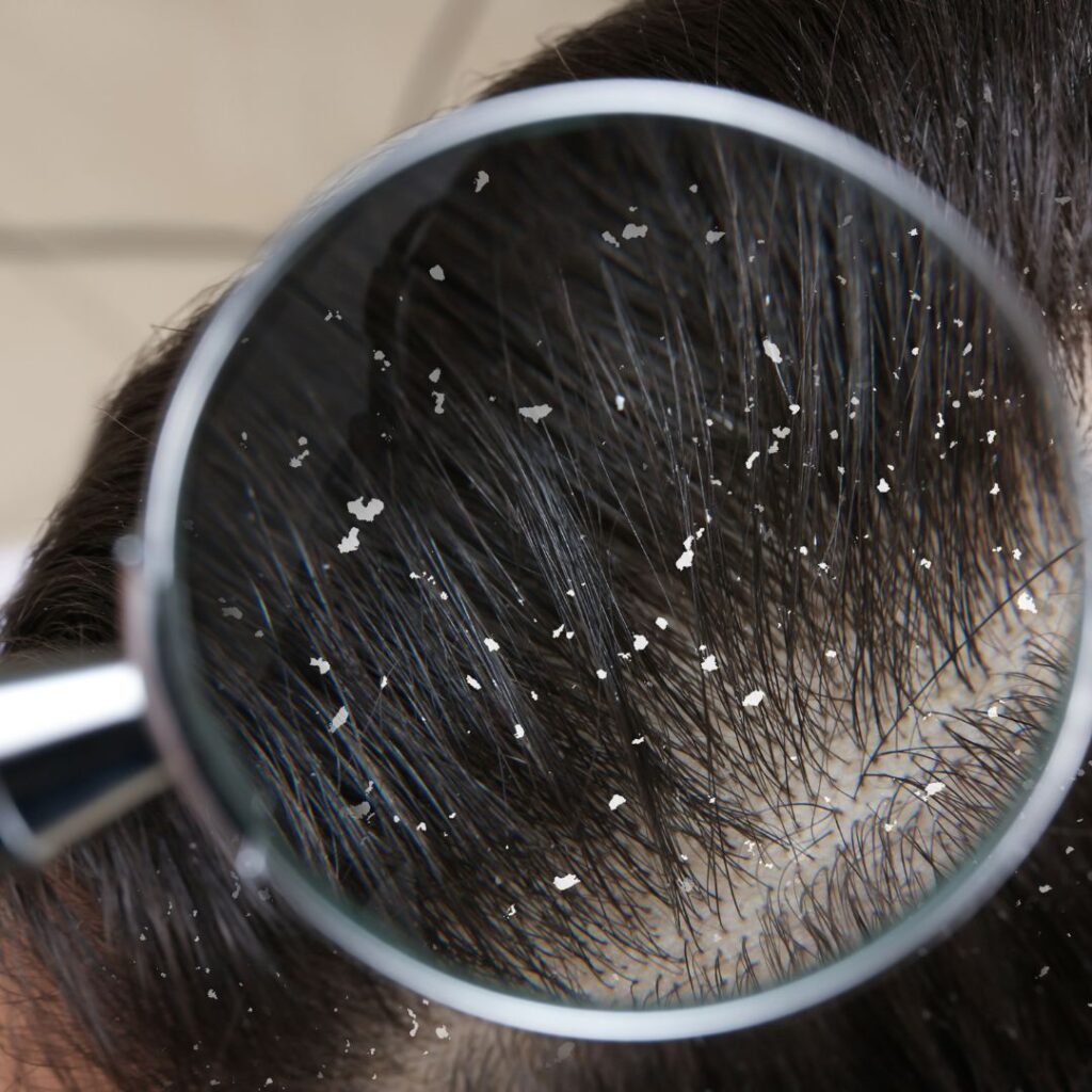 dandruff hair scalp analysis
