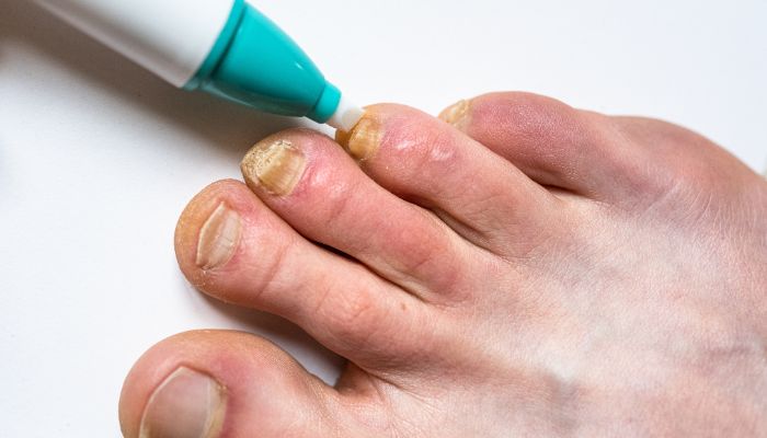 Nail Fungus - How to Recognize the Signs of Infection