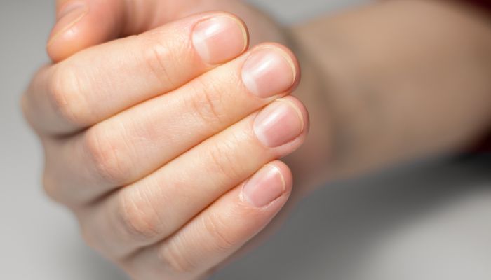 Is It Nail Fungus? Here’s How to Recognize the Signs of Infection