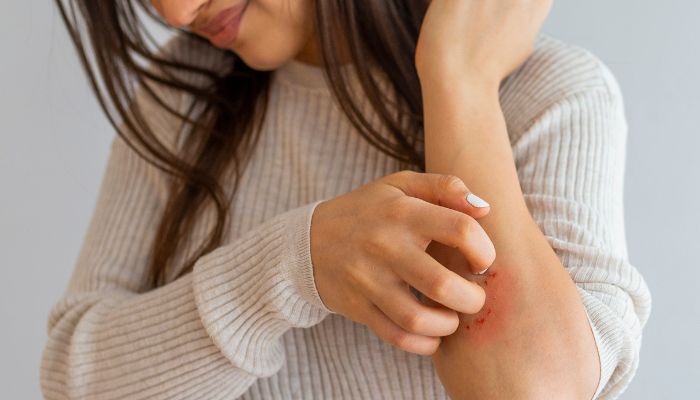 Banishing Winter Eczema with these expert tips