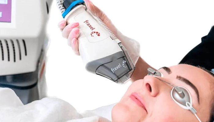 actinic keatosis laser treatment