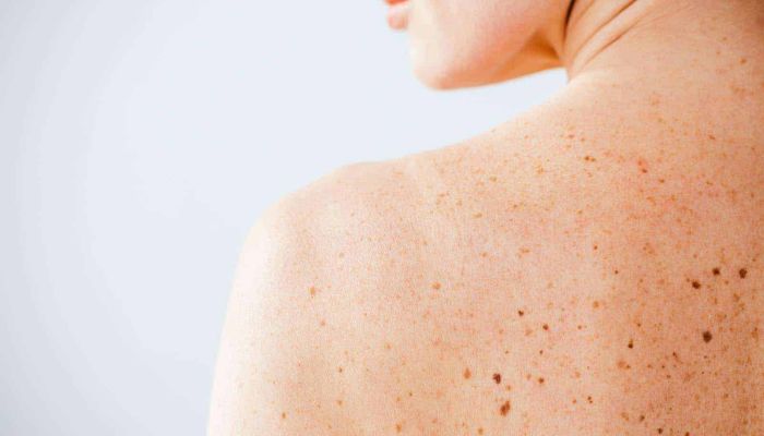 laser treatment for actinic keratosis NY